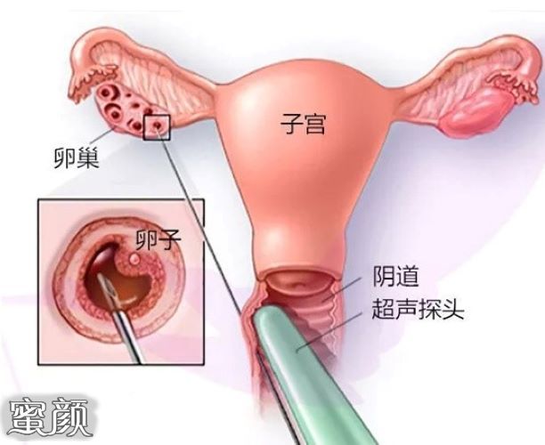 为什么在试管促排后有些女性会感觉到自己发胖了？